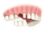 service_prosthodontics_bridge