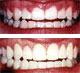 service_periodontics_gingivectomy
